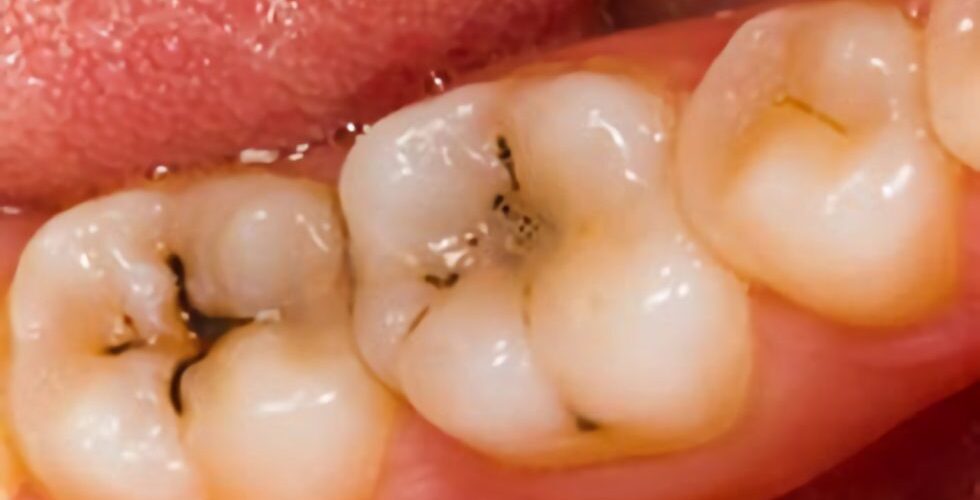 Cárie e erosão dentária: uma breve revisão