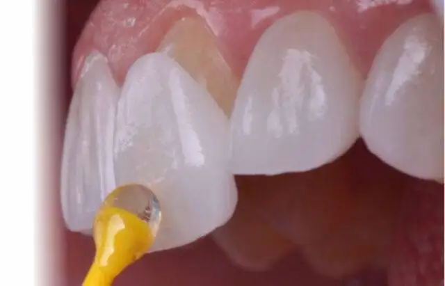 Lentes de contato dental, suas indicações e suas limitações
