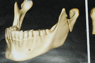 Fraturas do côndilo mandibular: classificação e tratamento