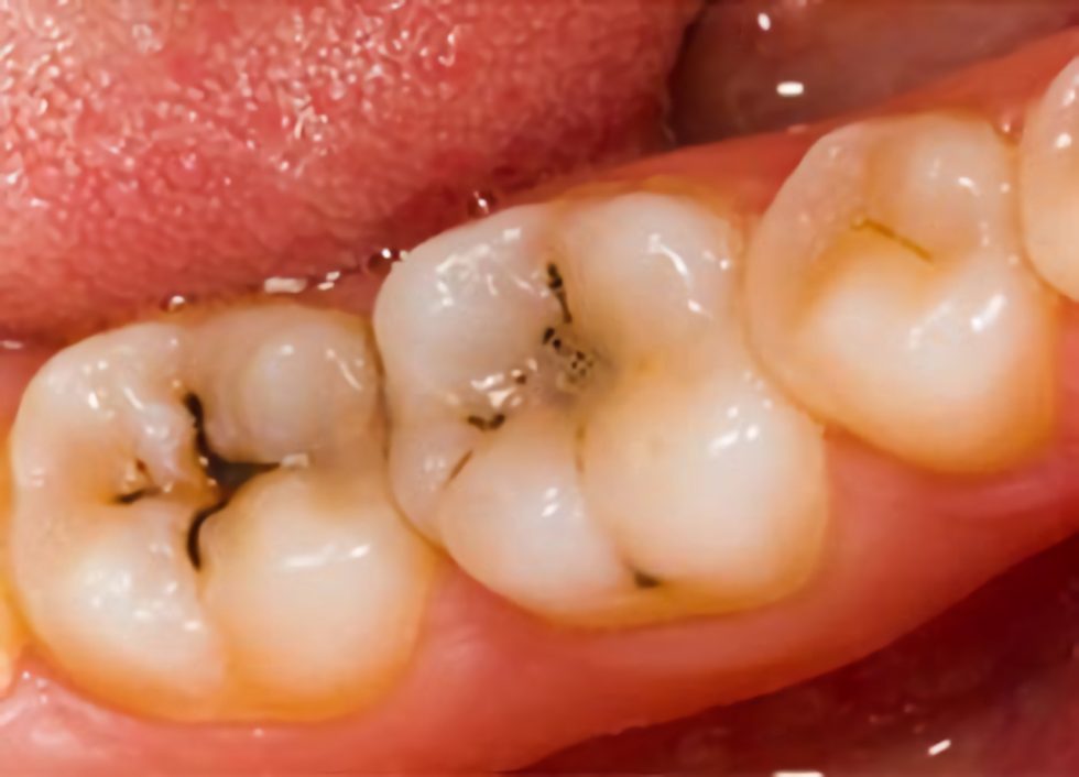 Detalhe de dente com lesão de cárie.