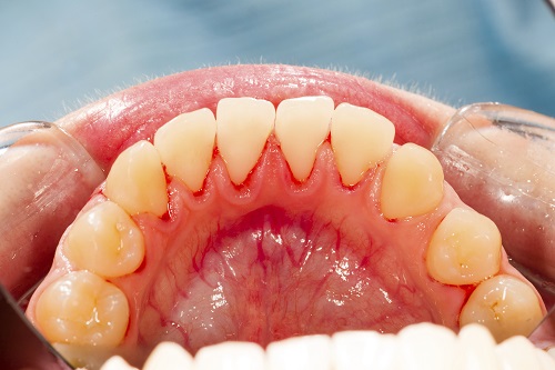 Gengiva inflamada, sinal de doença periodontal.