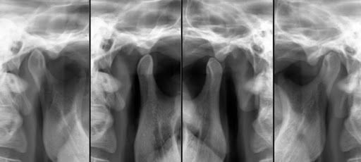 Radiografias de ATM em boca fechada e abertura máxima.