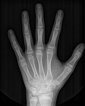 Radiografia carpal de mão e punho.