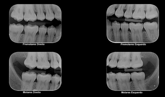 Radiografias interproximais, técnica bite-wing.
