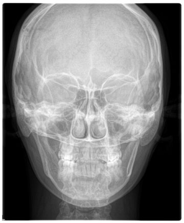 Radiografia póstero-anterior frontal do crânio.