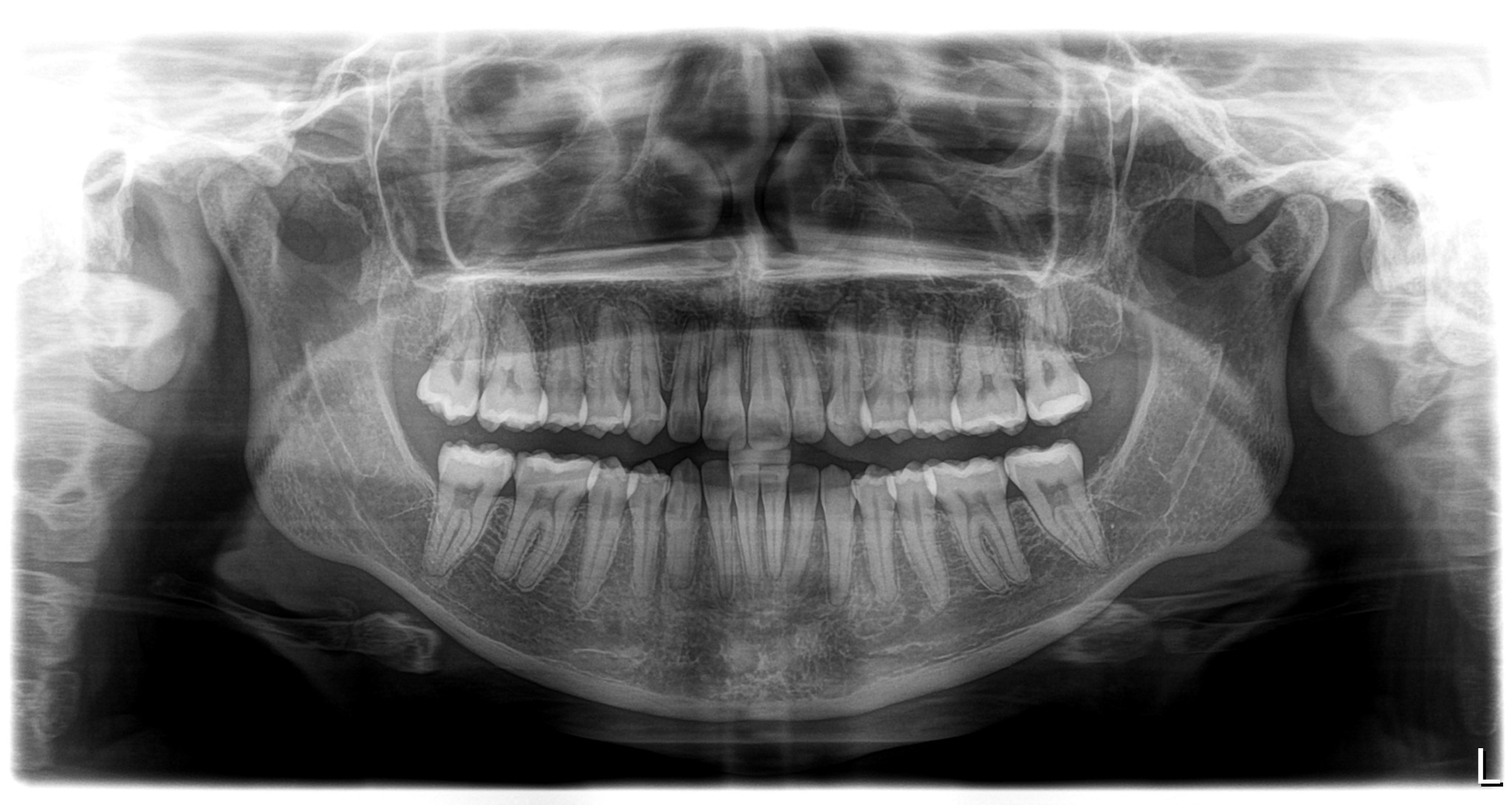 Radiografia panorâmica mostrando toda a arcada dentária.