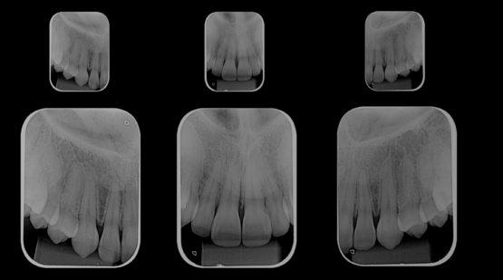Radiografia periapical de um grupo de dentes.