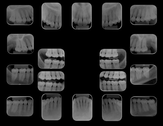 Exame periapical completo com 14 radiografias montadas.