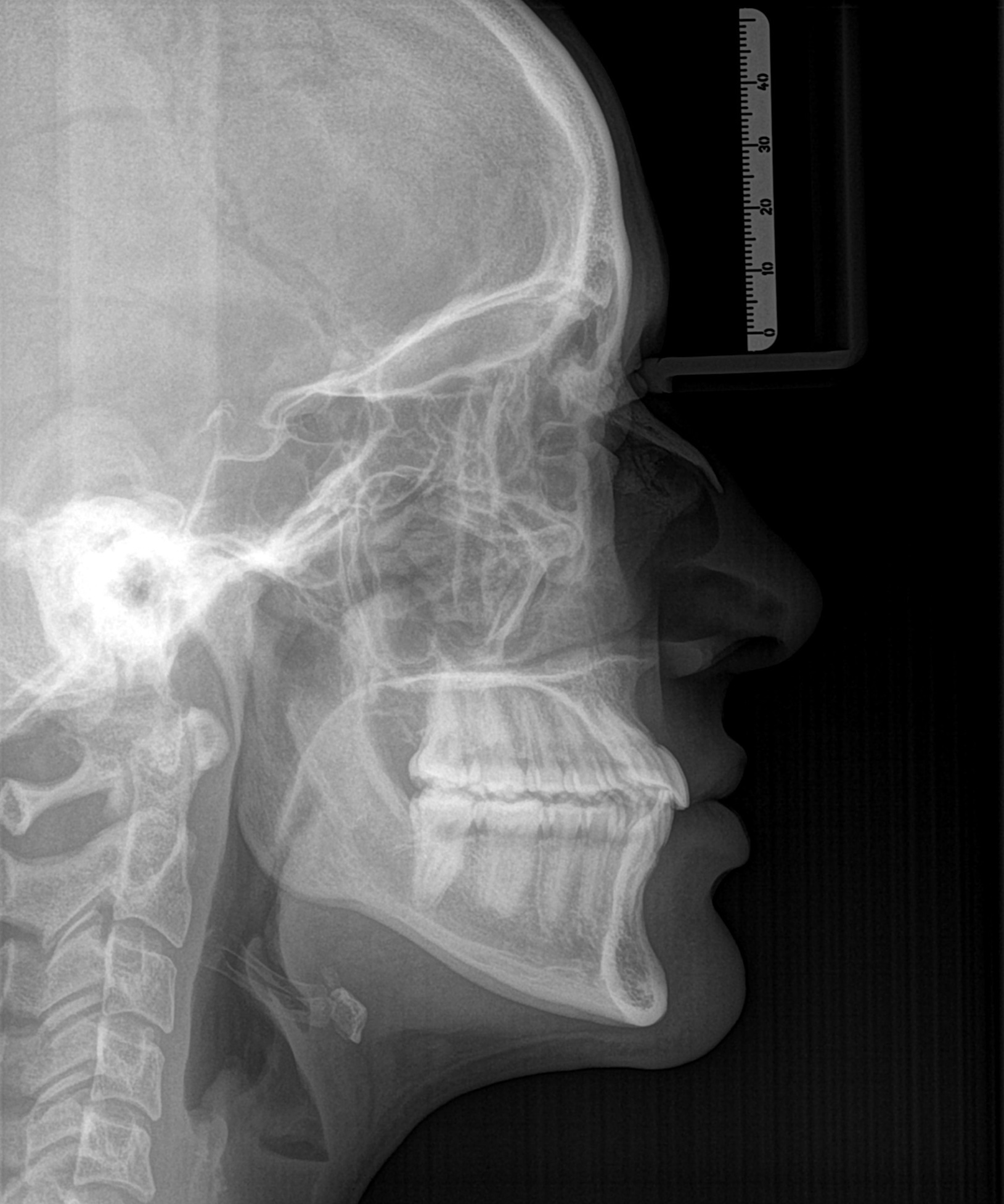 Telerradiografia lateral de crânio.