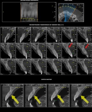 Corte tomográfico com medidas para planejamento de implante.